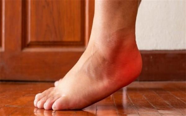 دلایل بروز درد در پاشنه پس از ورزش دلایل بروز درد در پاشنه پس از ورزش